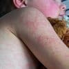 As measles cases rise, some parents become vaccine enthusiasts